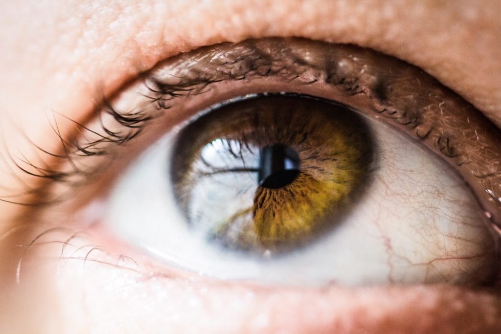 Keratoconus symptoms